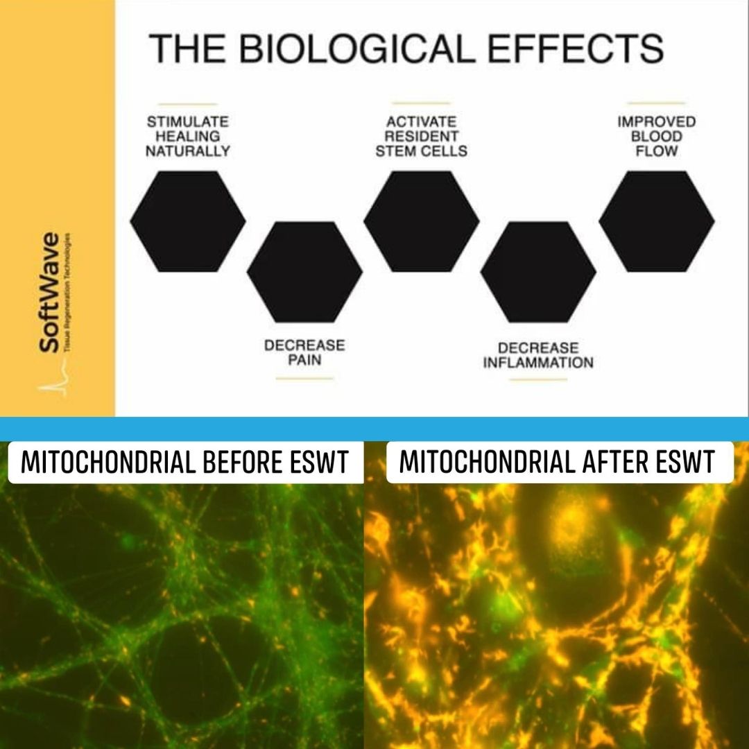 The Transformative Power of SoftWave Therapy: Delving into the Biological Effects and Mitochondrial Revitalization