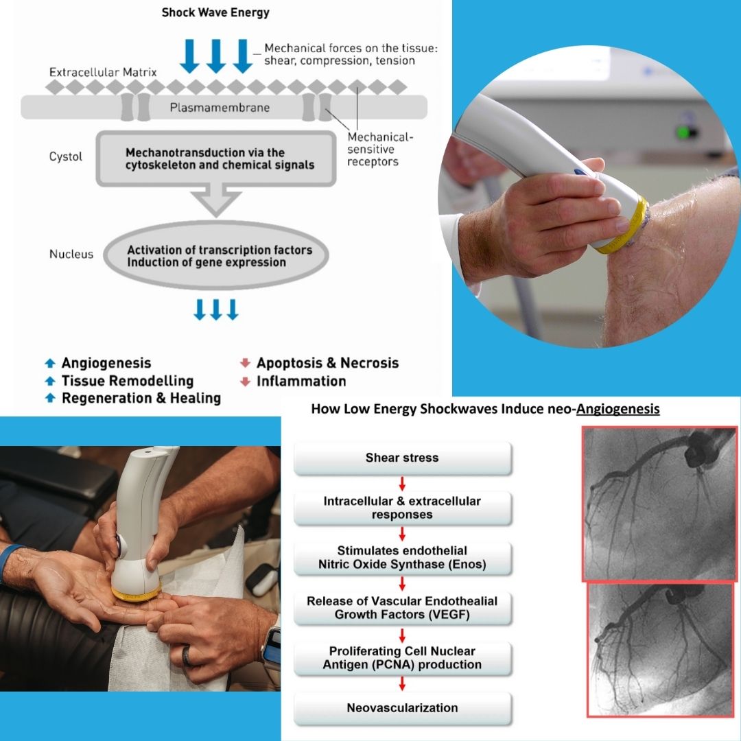 How Does SoftWave Tissue Regeneration Technology Stimulate, Activate, and Migrate Stem Cells for Tissue Repair and Regeneration?