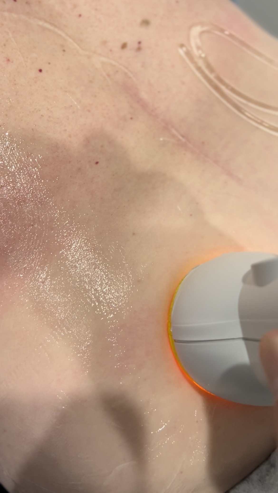 The Power of SoftWave Tissue Regeneration: Why it Outperforms Laser Therapy for Musculoskeletal Conditions