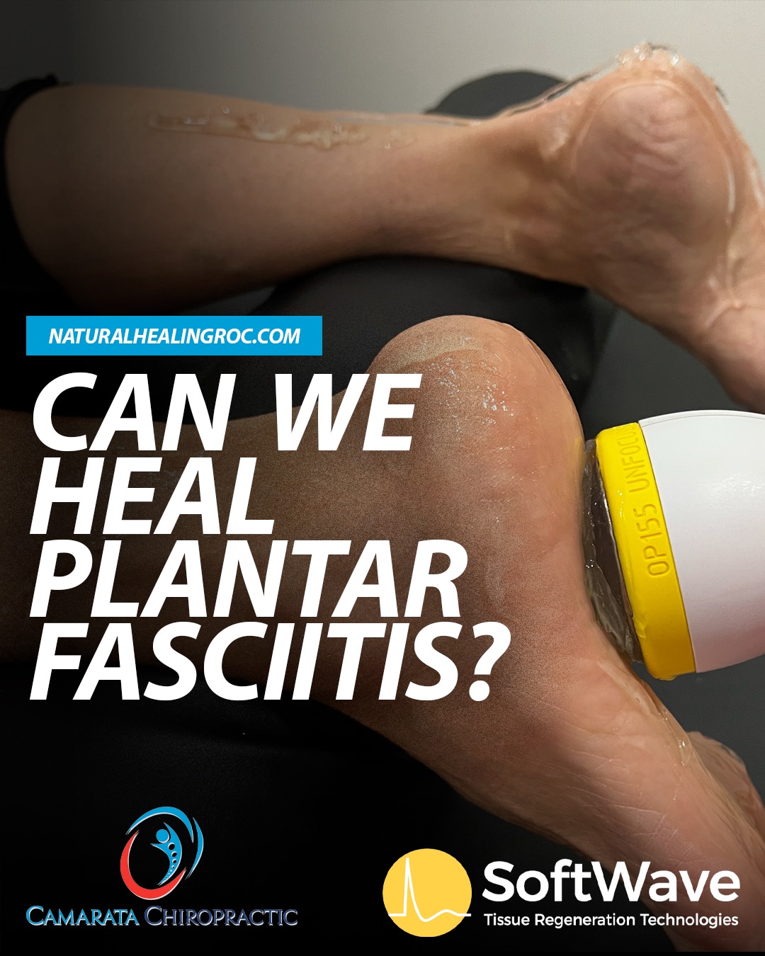 Can We Heal Plantar Fasciitis?! Exploring Solutions with SoftWave Tissue Regeneration Technology at Camarata Chiropractic & Wellness