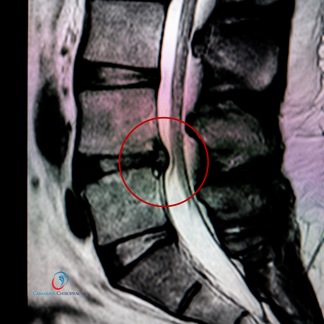 Tom's Journey: Overcoming Disc Herniation Pain Non-Surgically with SoftWave Therapy & Chiropractic Combined