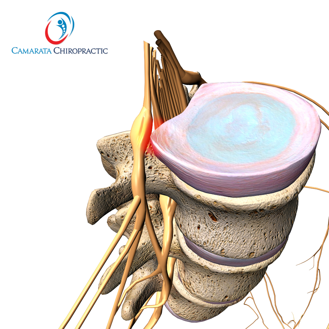 Understanding Disc Herniation Types and Embracing SoftWave Therapy for Lasting Pain Relief in Rochester NY