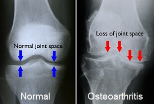 Revolutionizing Knee Arthritis Care: The Power of SoftWave Therapy