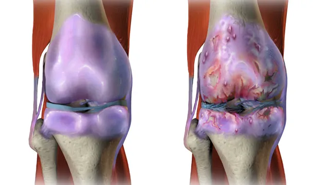 Say Goodbye to Arthritis Pain: How SoftWave Therapy Outperforms Laser Treatment for Joint Conditions