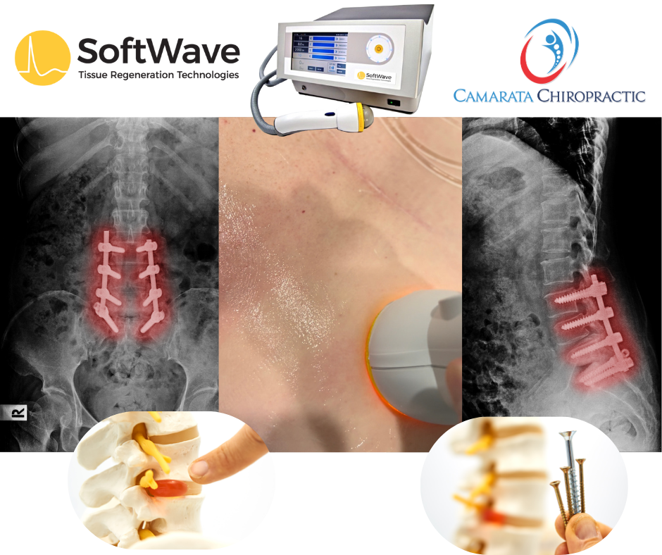 SoftWave Therapy After Spine Surgery?: A Safe and Effective Solution for Persistent Back Pain & Sciatica Relief