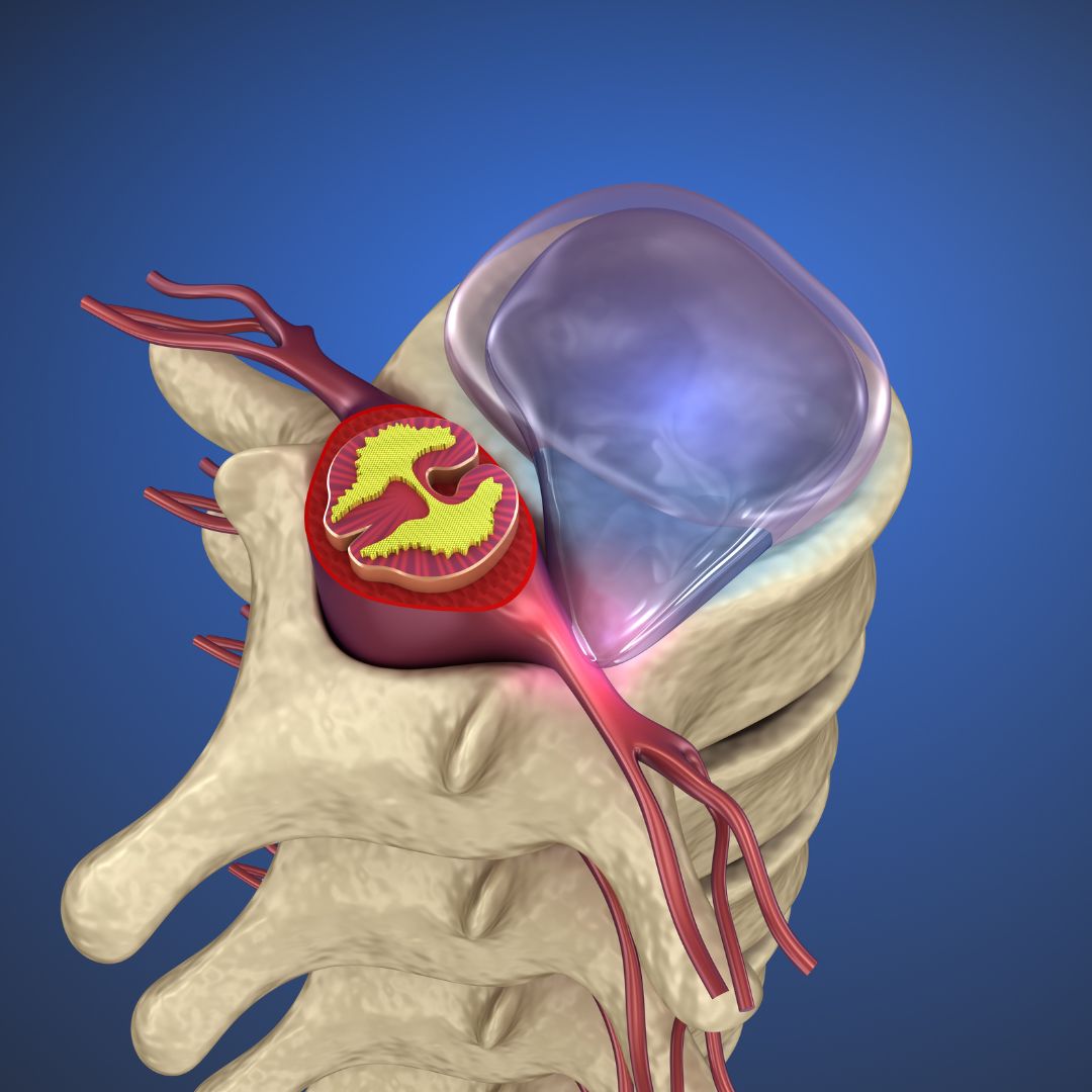 Understanding the Impact of SoftWave Tissue Regeneration Therapy on Disc Herniation in Rochester NY