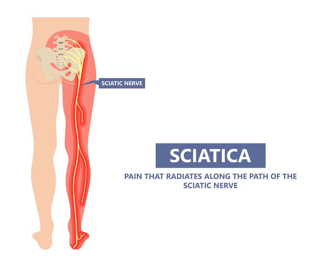 SoftWave Therapy: A Game-Changer for Sciatica Relief